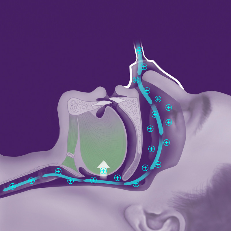 CPAP - Beatmung